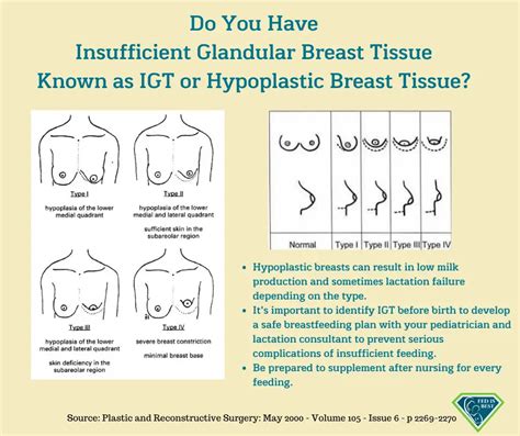 Hypoplastic Breasts 